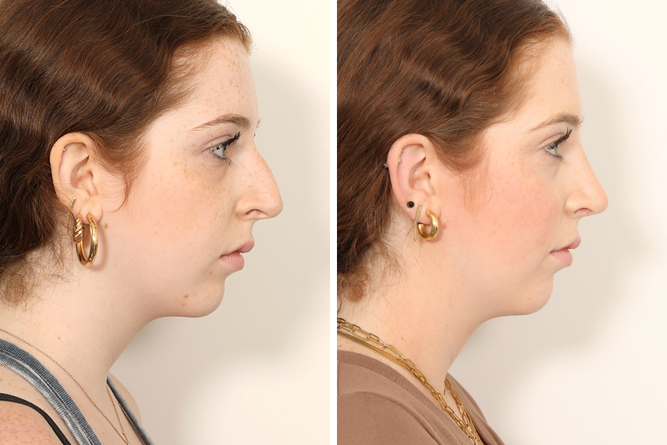 Rhinoplasty case #4050