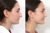 Rhinoplasty case #3983 slider thumbnail