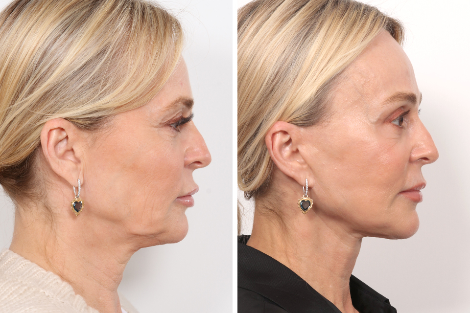 Facelift case #3760