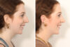 Rhinoplasty case #4050 slider thumbnail