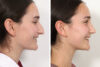 Rhinoplasty case #3983 slider thumbnail