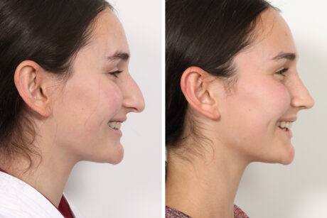 Rhinoplasty case #3983