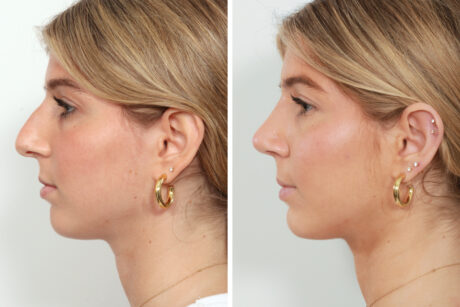 Rhinoplasty case #4070