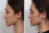 Rhinoplasty case #4075 slider thumbnail