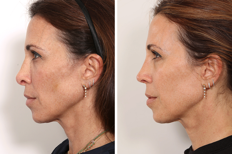 Rhinoplasty case #3961