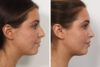 Rhinoplasty case #3944 slider thumbnail
