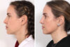 Rhinoplasty case #3977 slider thumbnail