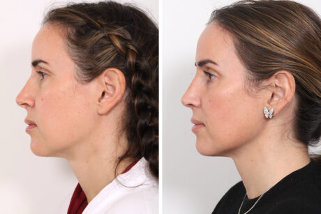 Rhinoplasty case #3977