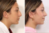 Rhinoplasty case #4082 slider thumbnail