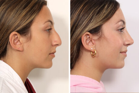 Rhinoplasty case #4082