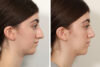 Rhinoplasty case #4107 slider thumbnail