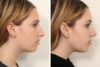 Rhinoplasty case #4135 slider thumbnail