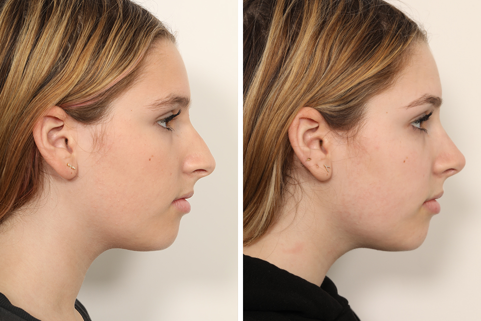 Rhinoplasty case #4135