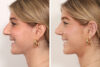 Rhinoplasty case #4070 slider thumbnail