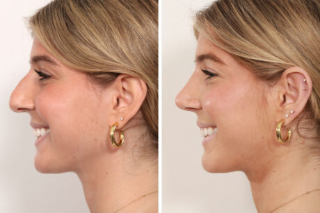 Rhinoplasty case #4070