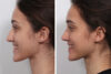 Rhinoplasty case #4075 slider thumbnail