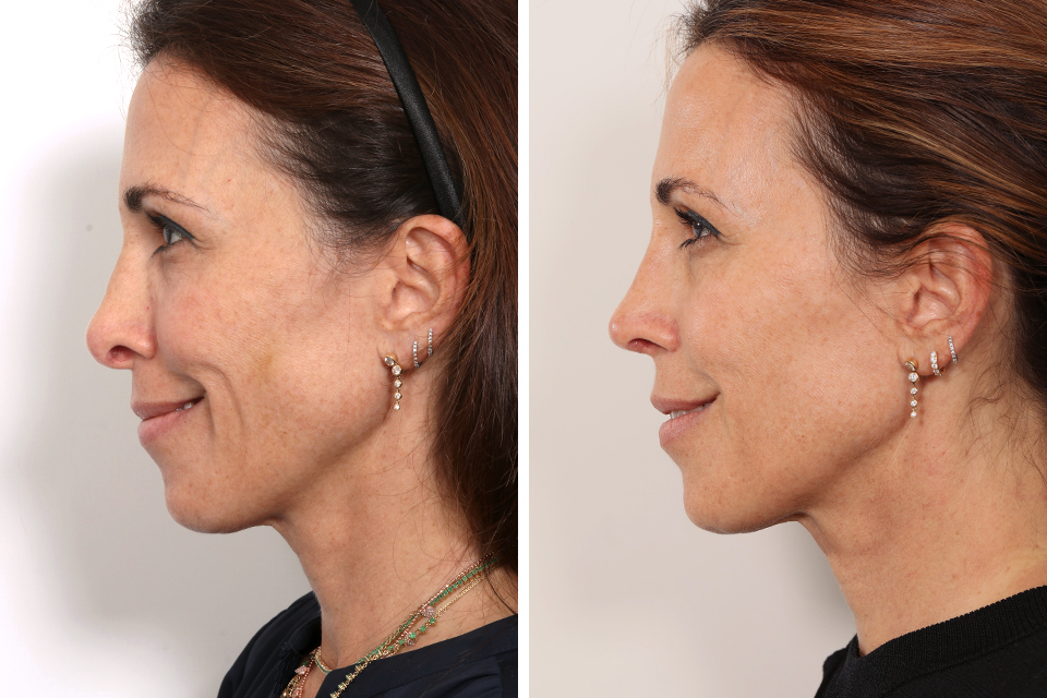 Rhinoplasty case #3961
