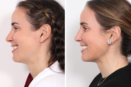 Rhinoplasty case #3977
