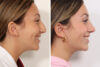 Rhinoplasty case #4082 slider thumbnail