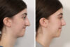 Rhinoplasty case #4107 slider thumbnail