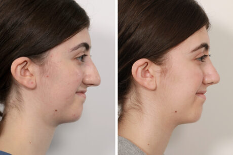 Rhinoplasty case #4107