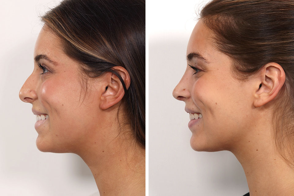 Rhinoplasty case #3944