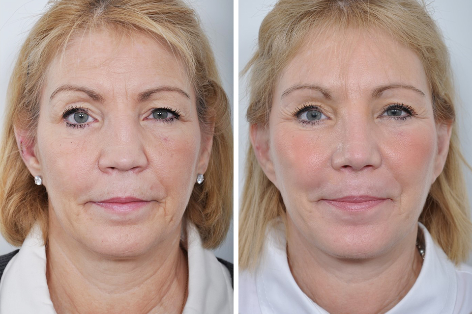 Brow Lift case #4487