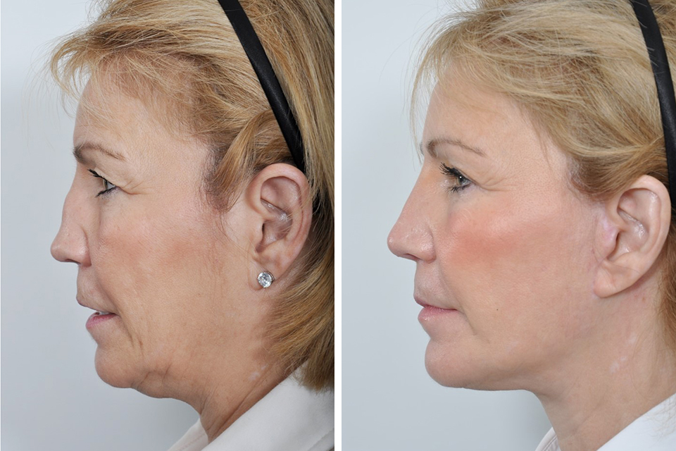 Brow Lift case #4487