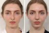 Rhinoplasty case #3992 slider thumbnail