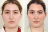 Rhinoplasty case #3956 slider thumbnail