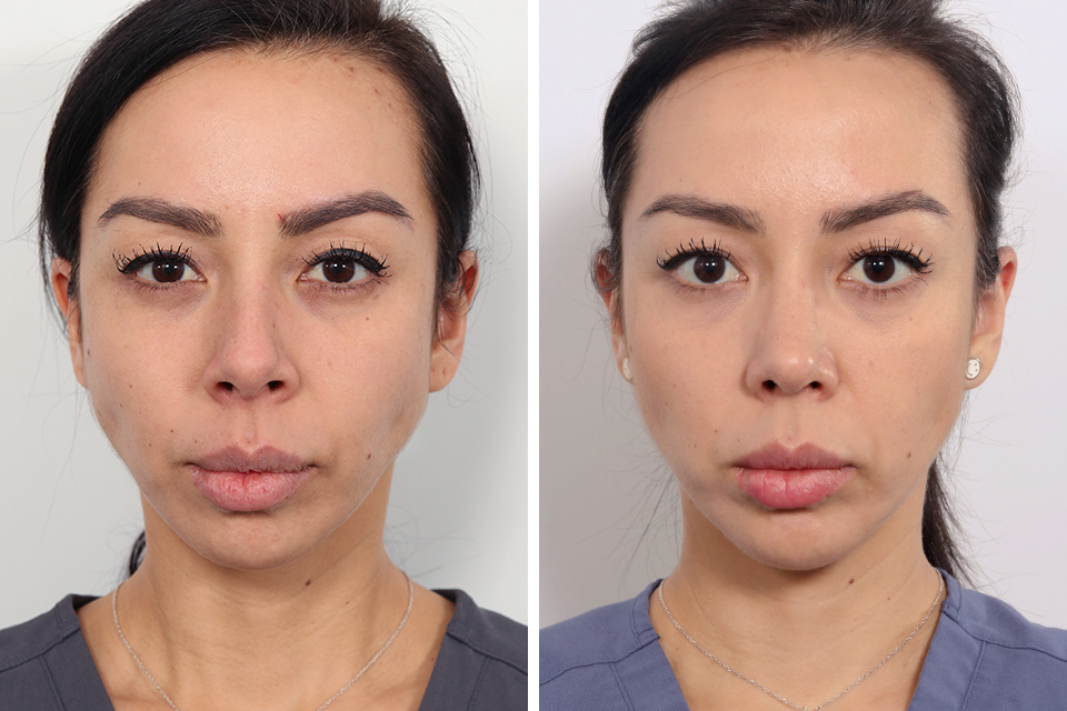 Rhinoplasty case #4013