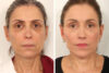 Rhinoplasty case #4029 slider thumbnail