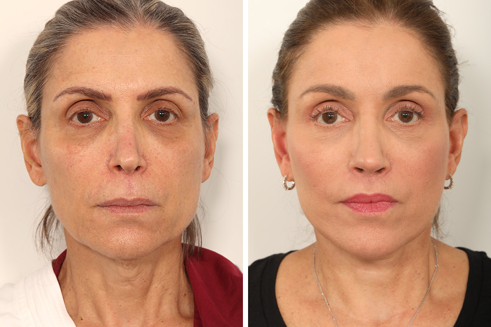 Rhinoplasty case #4029