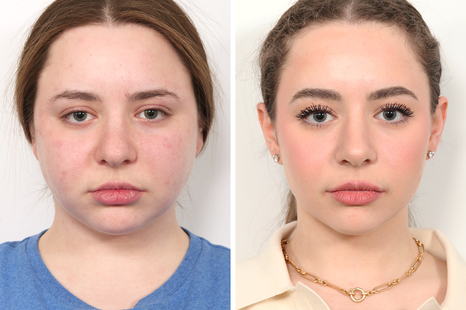 Rhinoplasty case #4023