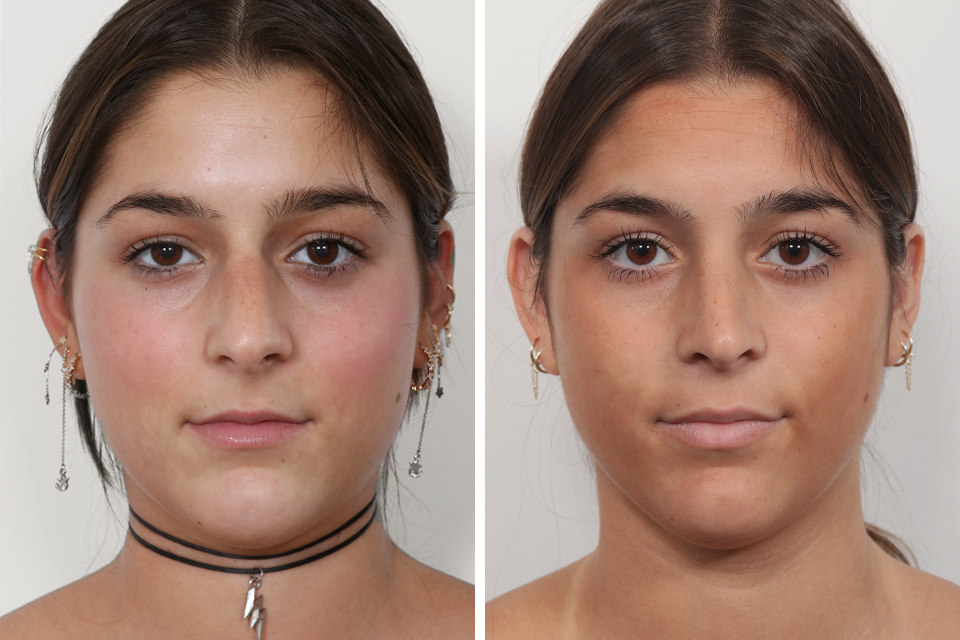 Rhinoplasty case #4036