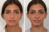 Rhinoplasty case #4058 slider thumbnail