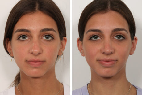 Rhinoplasty case #4058