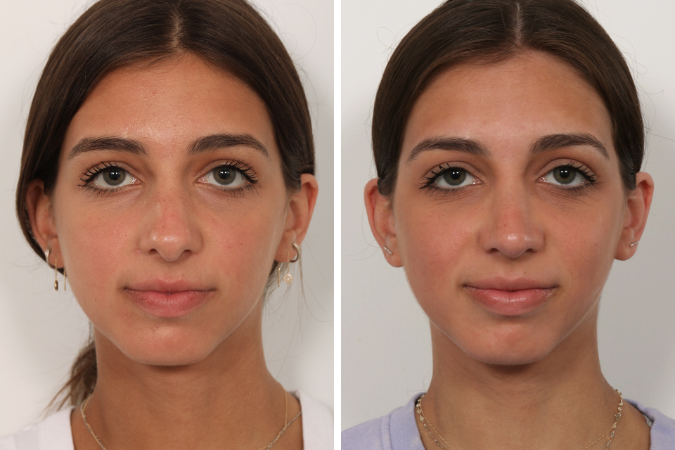 Rhinoplasty case #4058