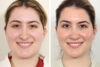 Rhinoplasty case #3956 slider thumbnail