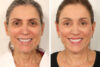 Rhinoplasty case #4029 slider thumbnail