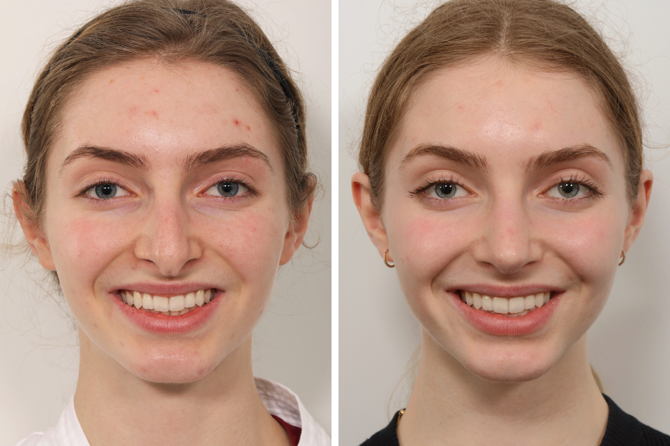 Rhinoplasty case #3992