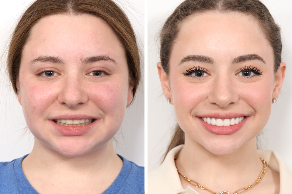 Rhinoplasty case #4023