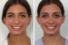Rhinoplasty case #4058 slider thumbnail
