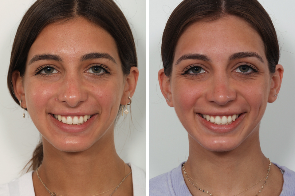 Rhinoplasty case #4058