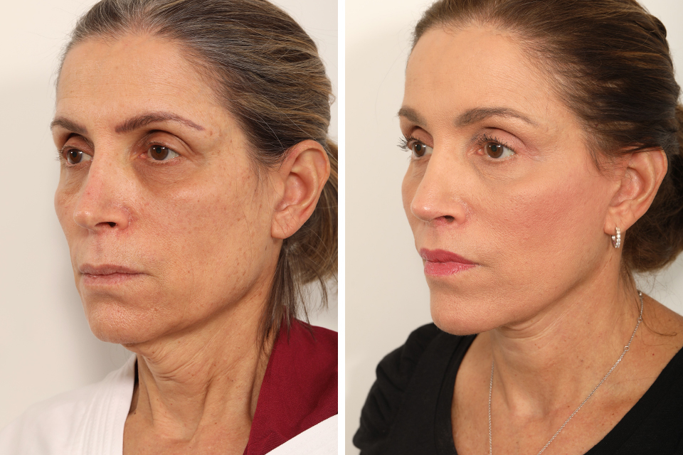 Rhinoplasty case #4029