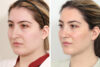 Rhinoplasty case #3956 slider thumbnail