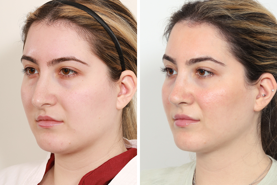 Rhinoplasty case #3956