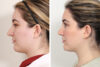 Rhinoplasty case #3956 slider thumbnail