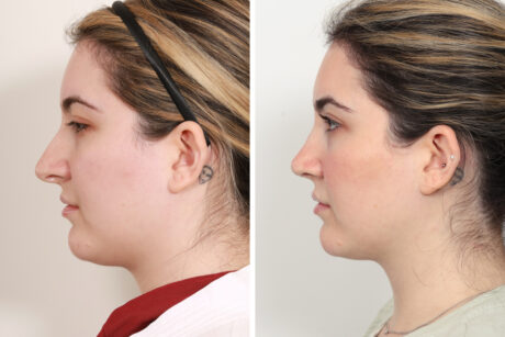 Rhinoplasty case #3956