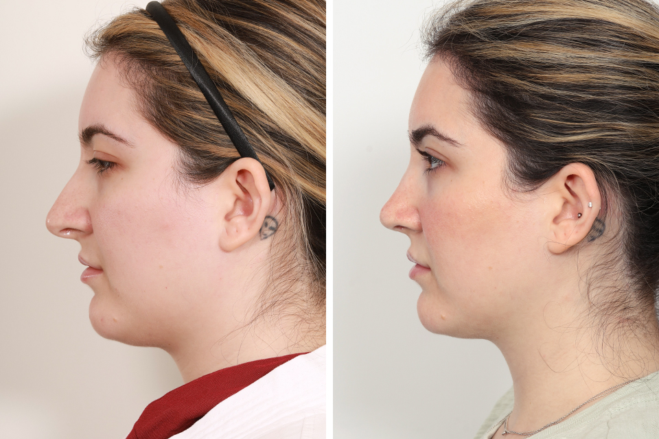Rhinoplasty case #3956